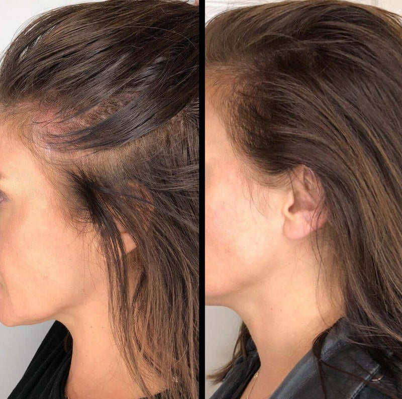 hairloss_before&after_2.jpg__PID:82d60031-23d3-42b8-957d-fd9bc6d109ff