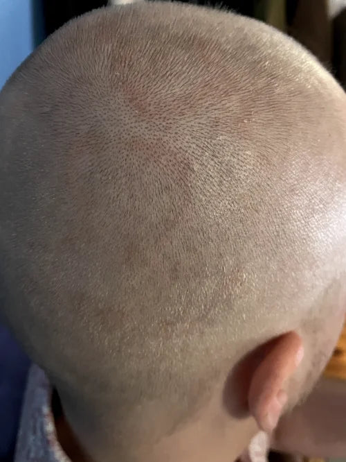 after_scalp.webp__PID:f1689001-6cc2-48fb-a5a8-5b50344c3905