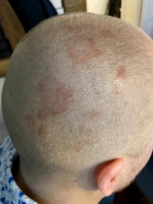 Scalp balance